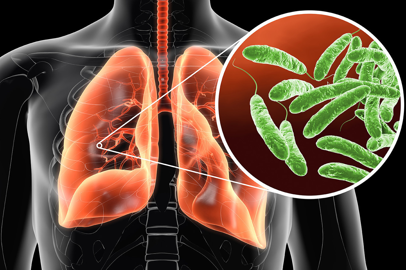 Eine 3D-Darstellung einer menschlichen Lunge in einem durchsichtigen Körper, daraus herausstechend eine Großaufnahme von grünen, stabförmigen Bakterien, den Legionellen